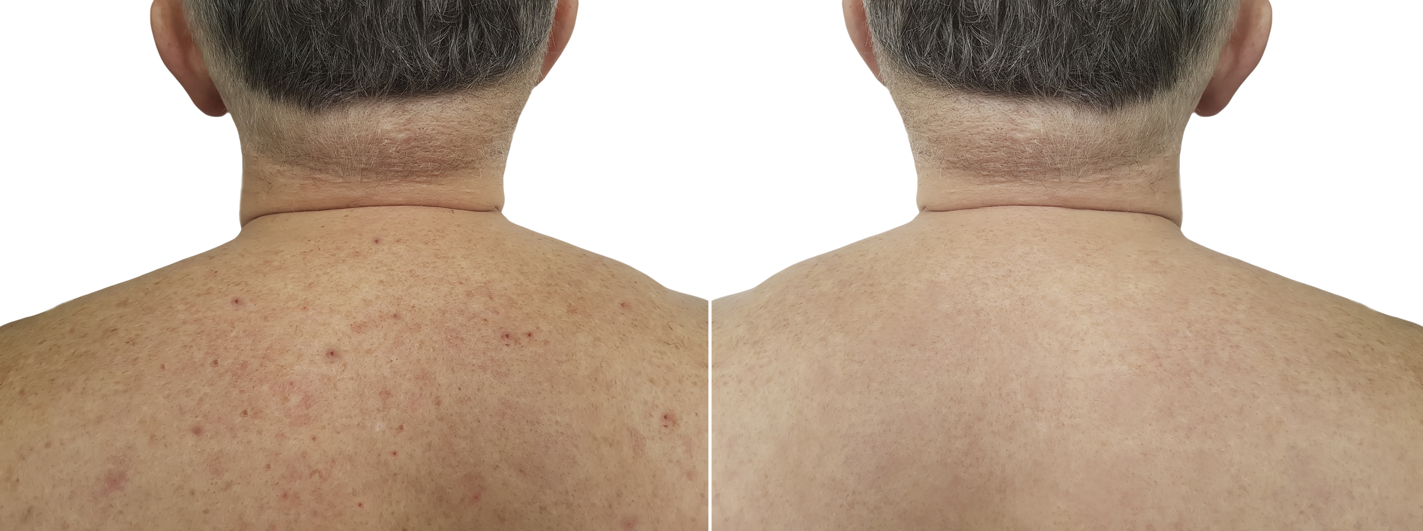 Before and after IPL treatment on back — dramatic clearing of acne, red spots and sun damage
